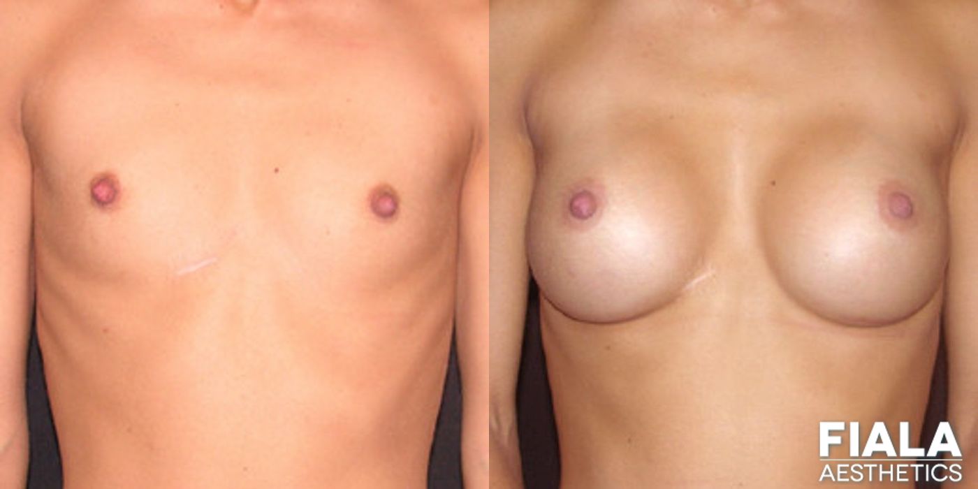 300cc Implants - Case 9129