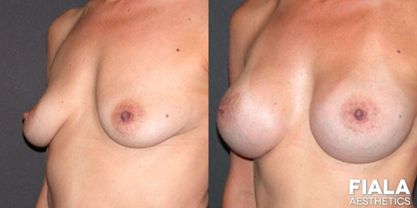 300cc Implants - Case 9130