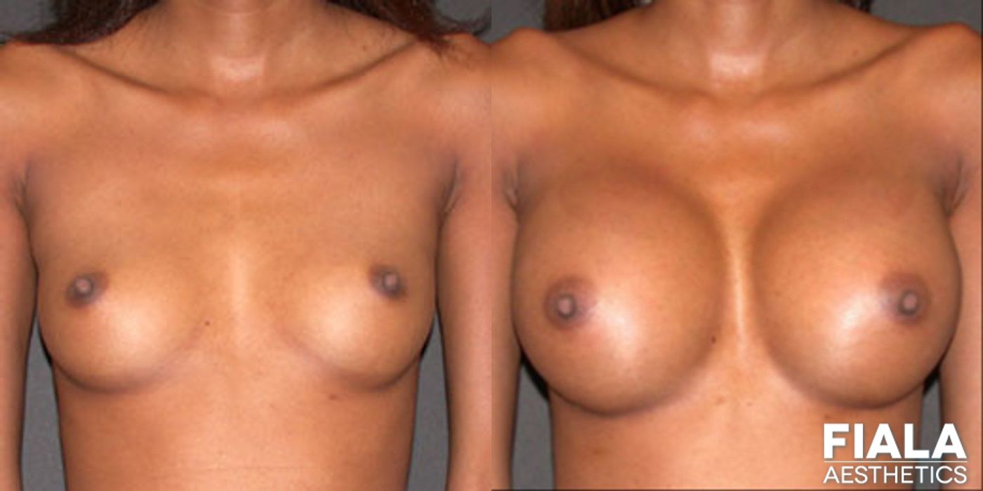 300cc Implants - Thumbnail 2