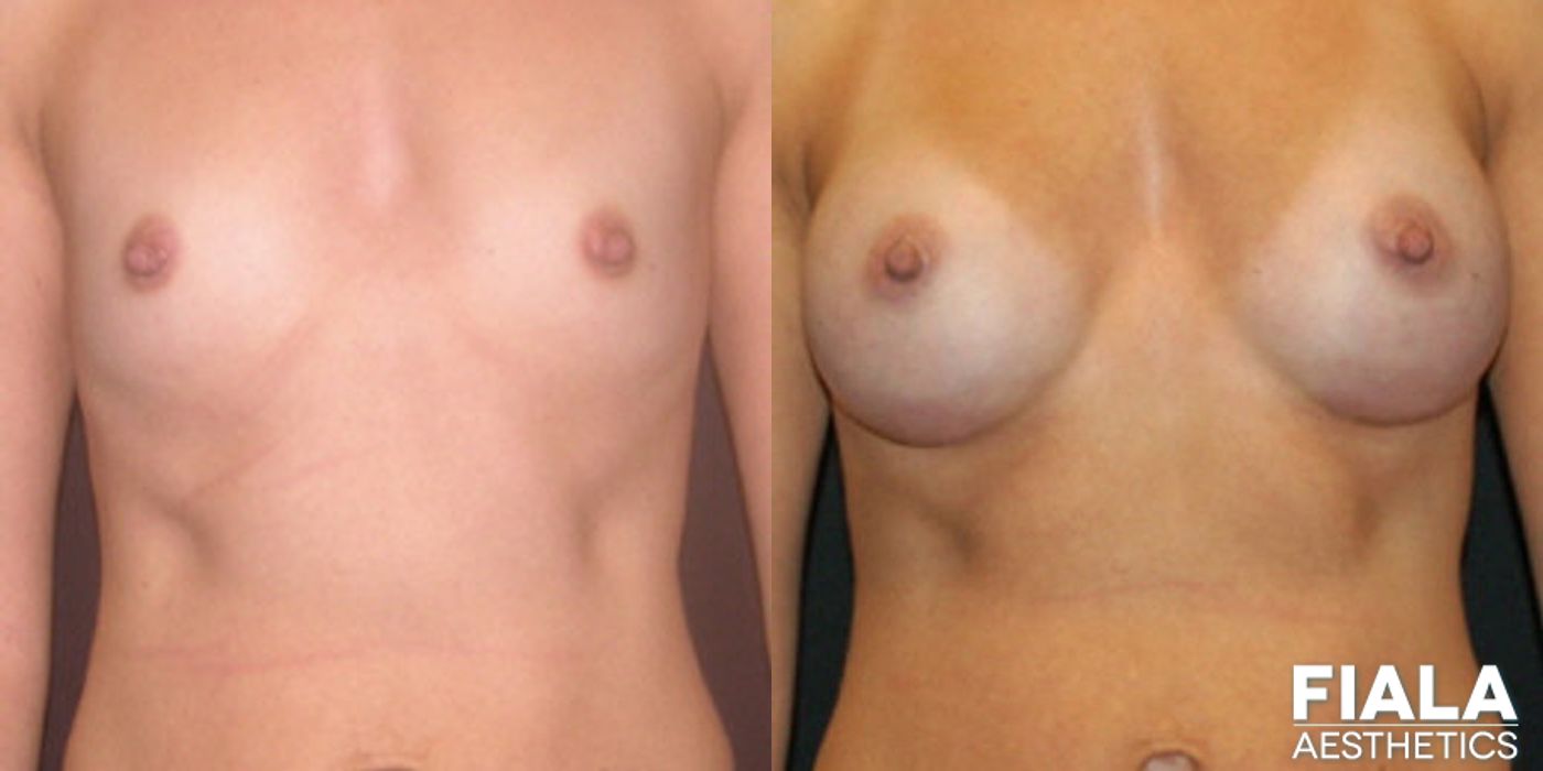 300cc Implants - Case 9120