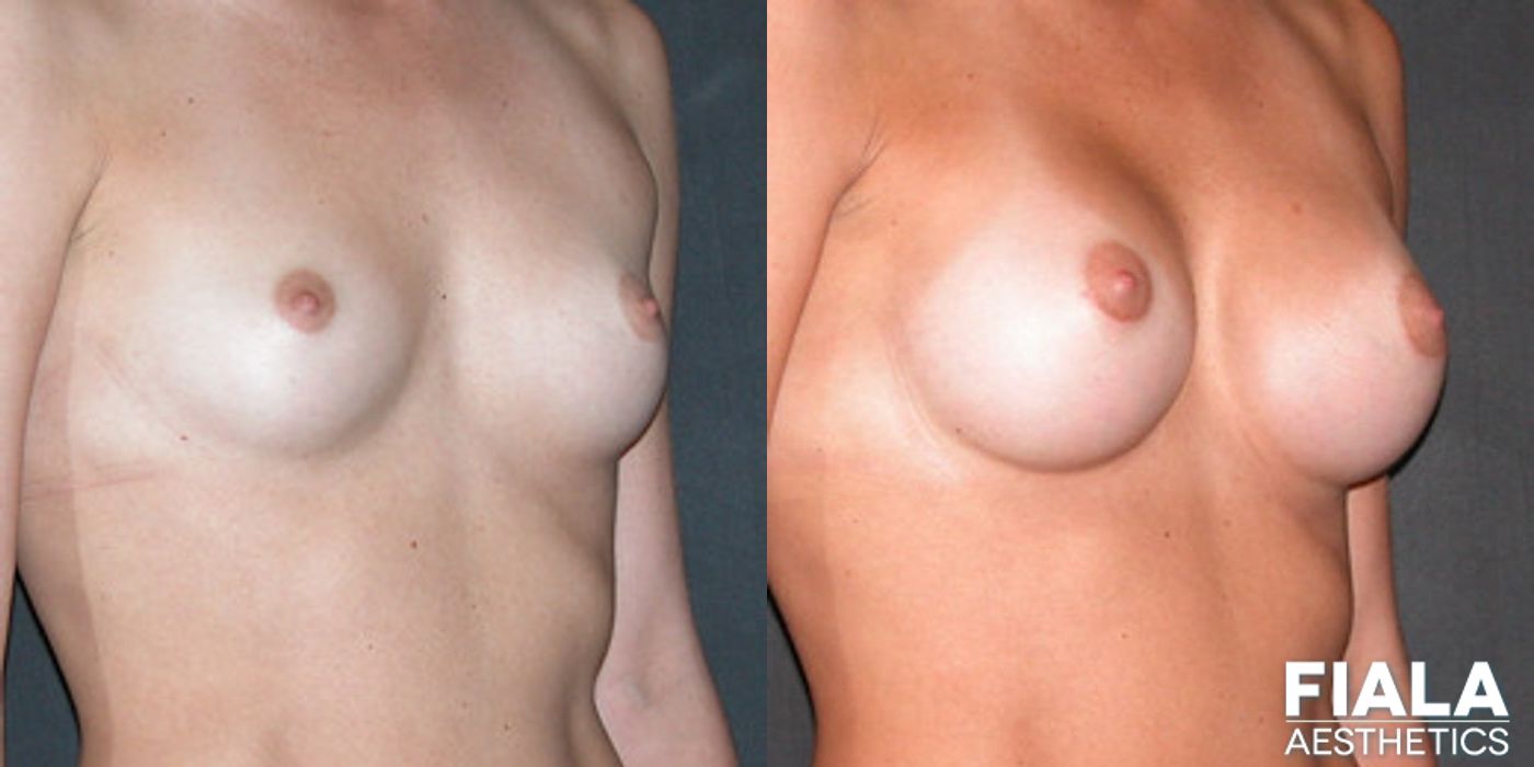 300cc Implants - Thumbnail 2