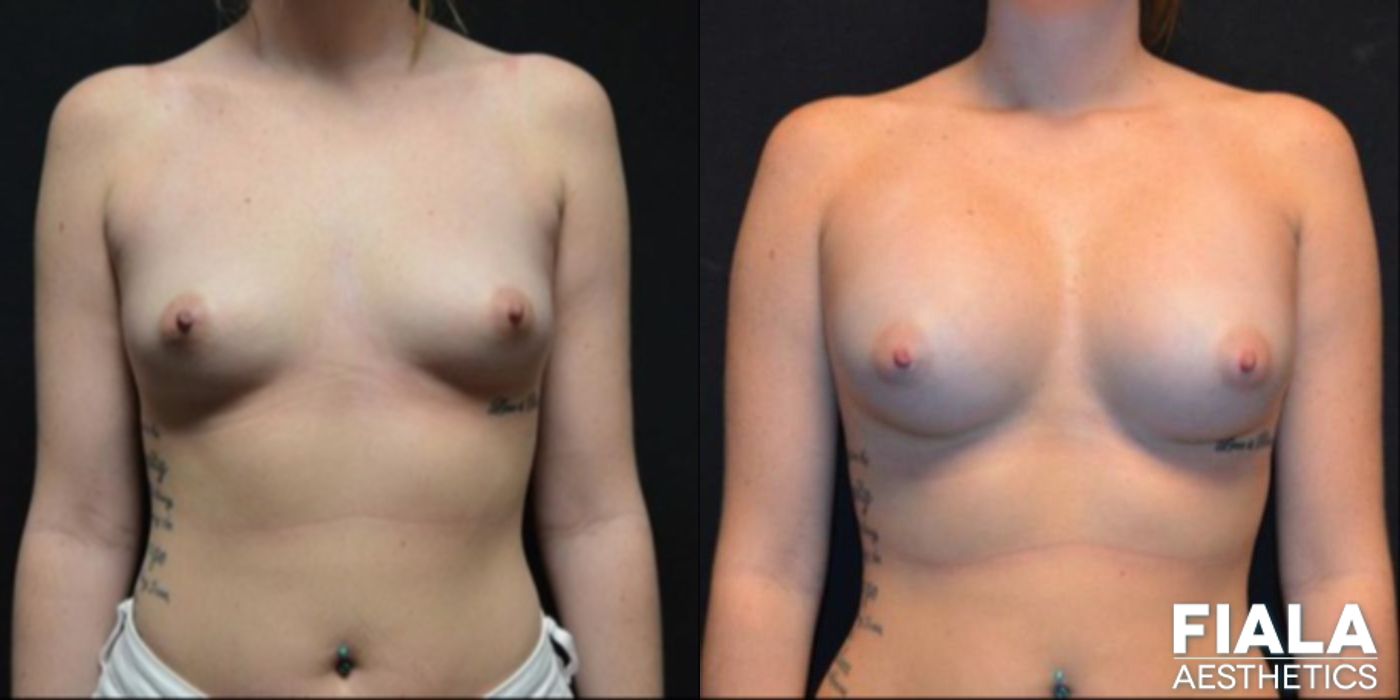 300cc Implants - Case 9106