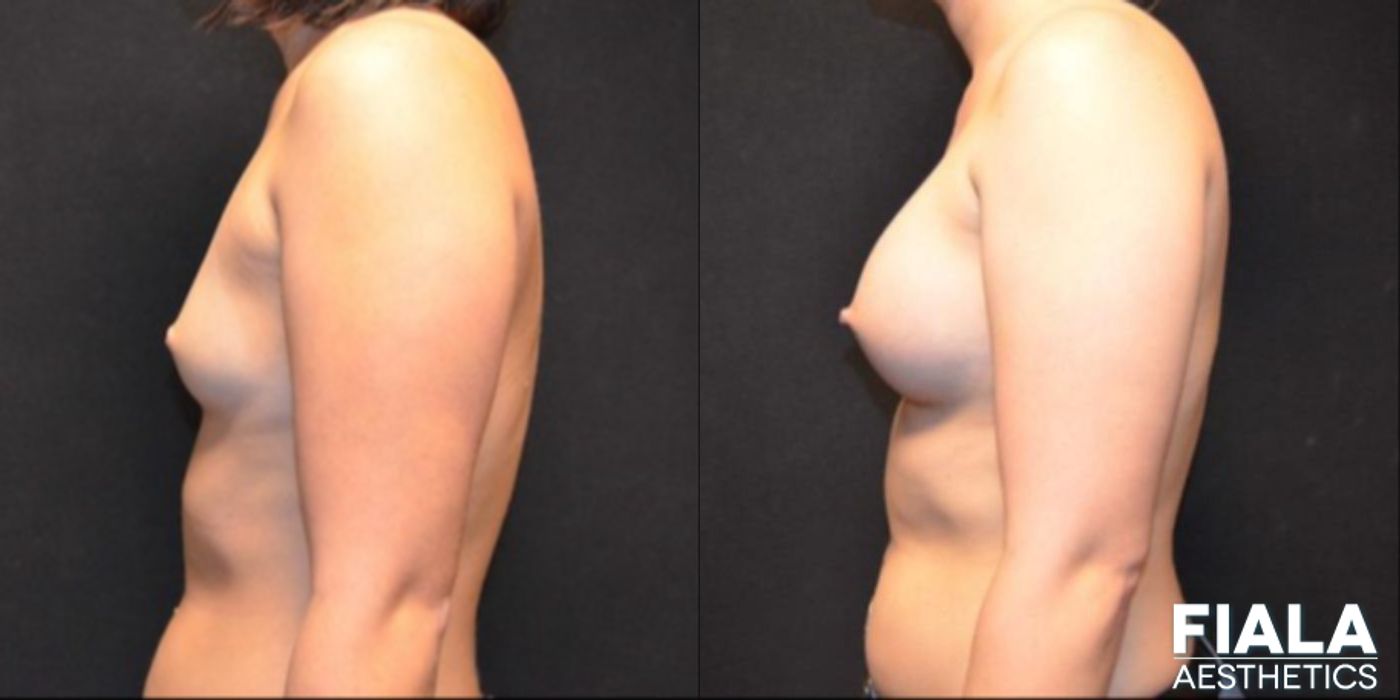 300cc Implants - Case 9107