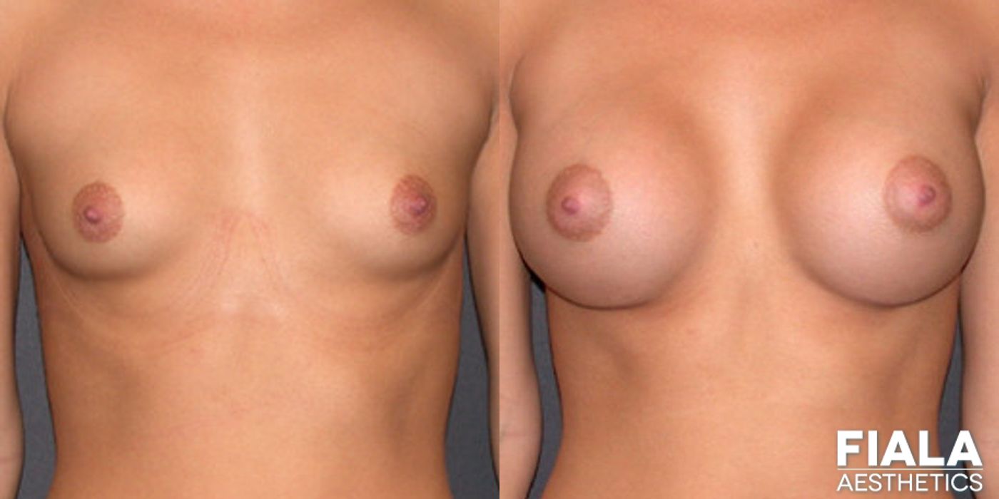 300cc Implants - Case 9110