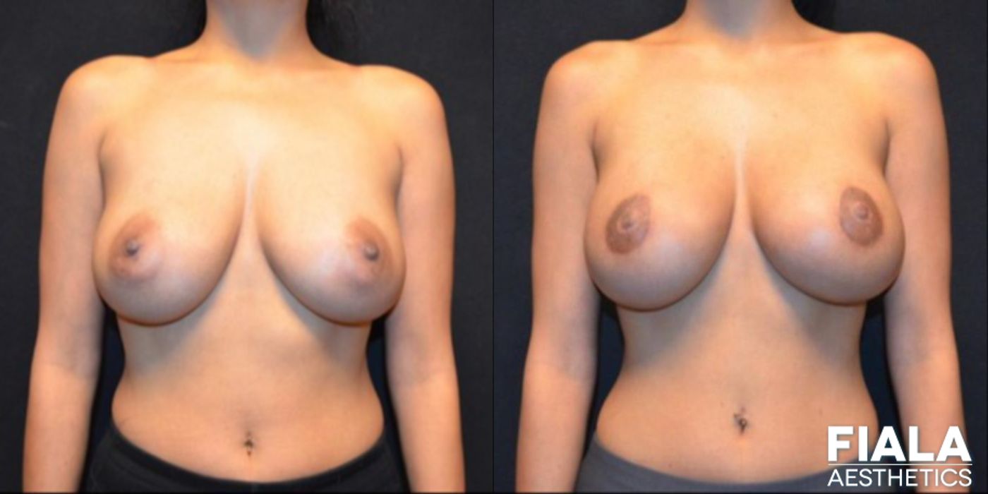 300cc Implants - Case 9109