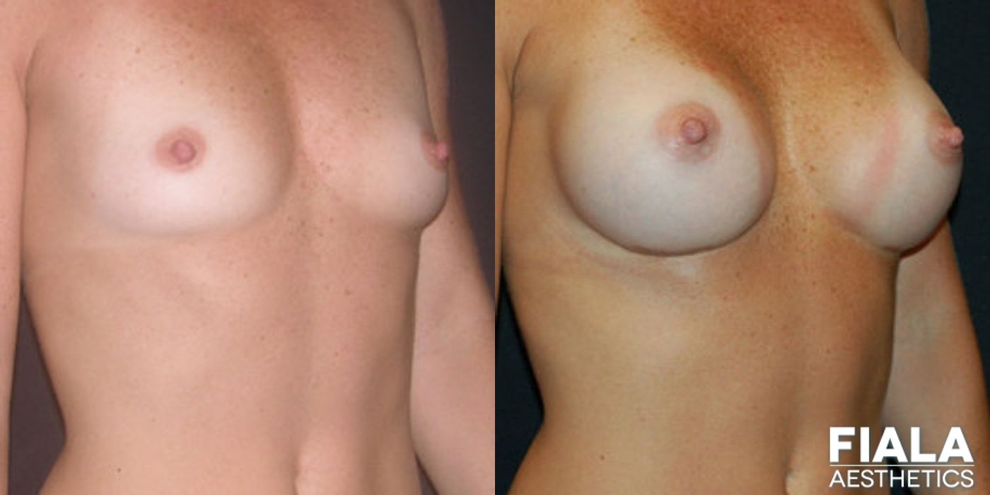 300cc Implants - Thumbnail 2