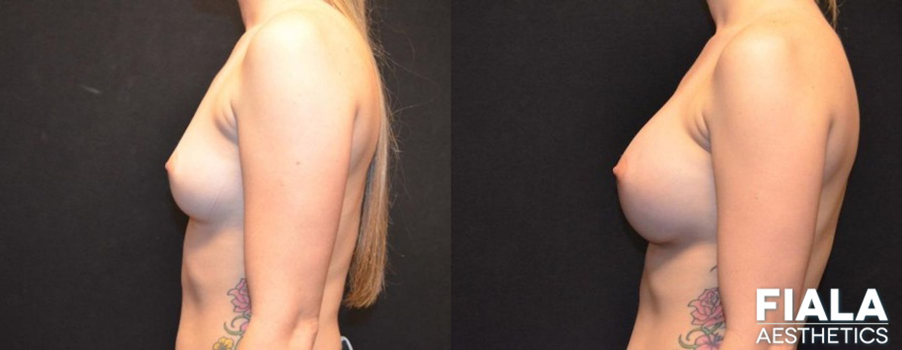 300cc Implants - Thumbnail 2