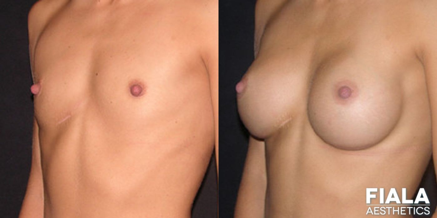 300cc Implants - Thumbnail 2