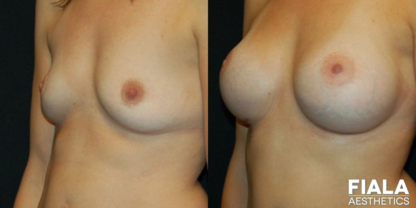 300cc Implants - Thumbnail 2