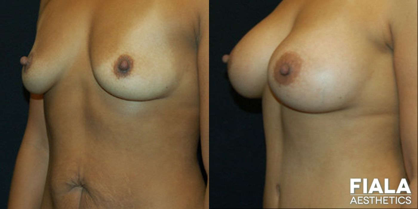 Before and after Tummy Tuck case 13687 - Angle 2