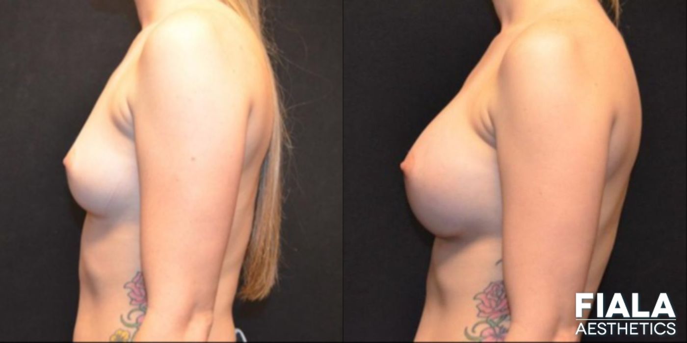 Before and after 300cc Implants case 13673 - Angle 2