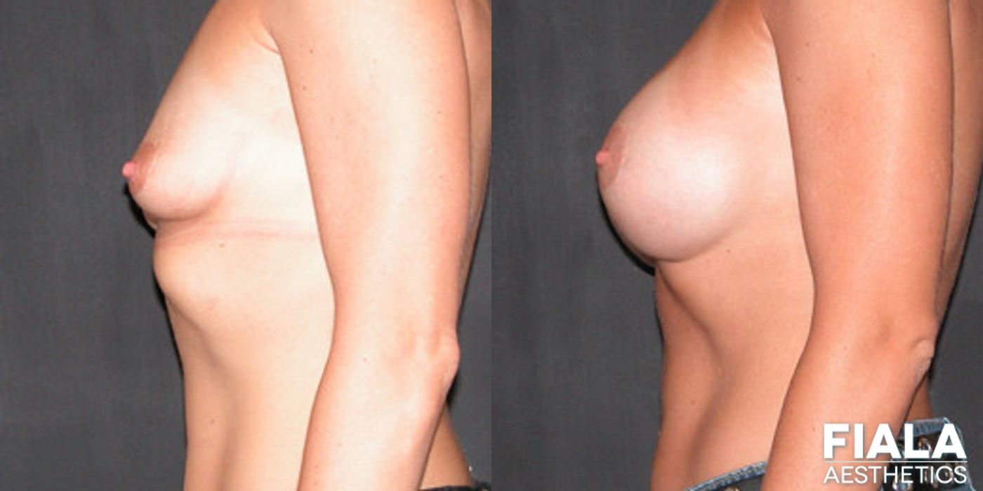 300cc Implants - Case 9122