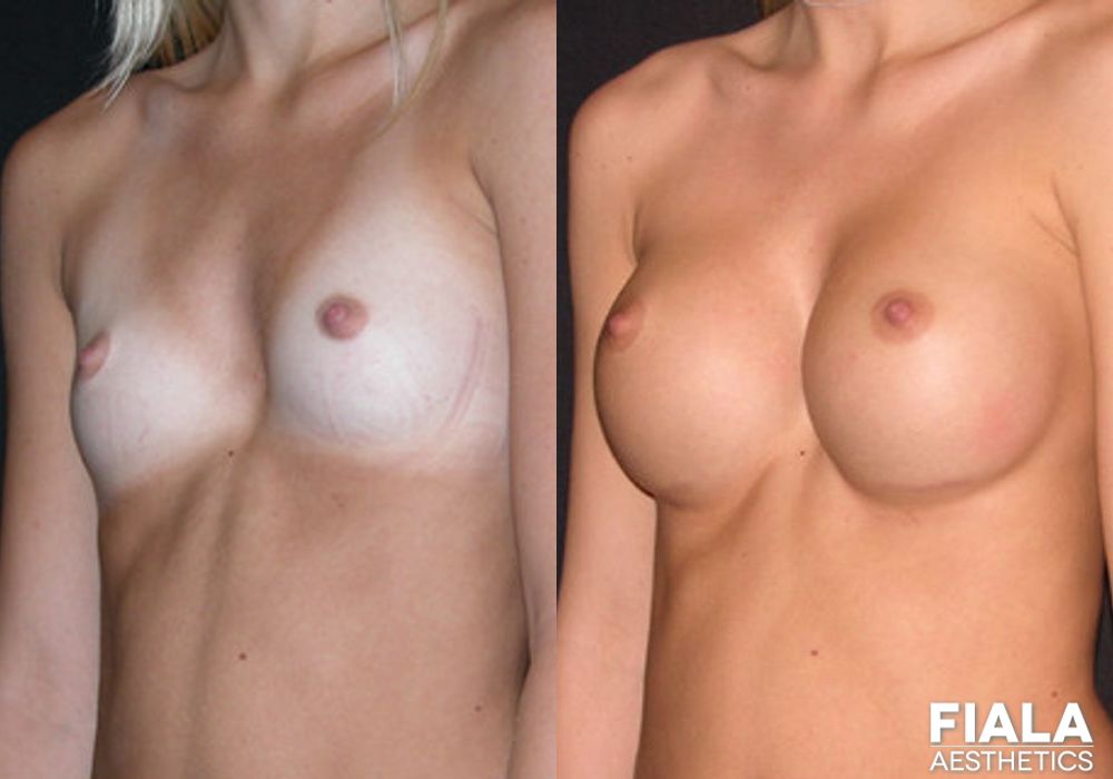 300cc Implants - Case 8911