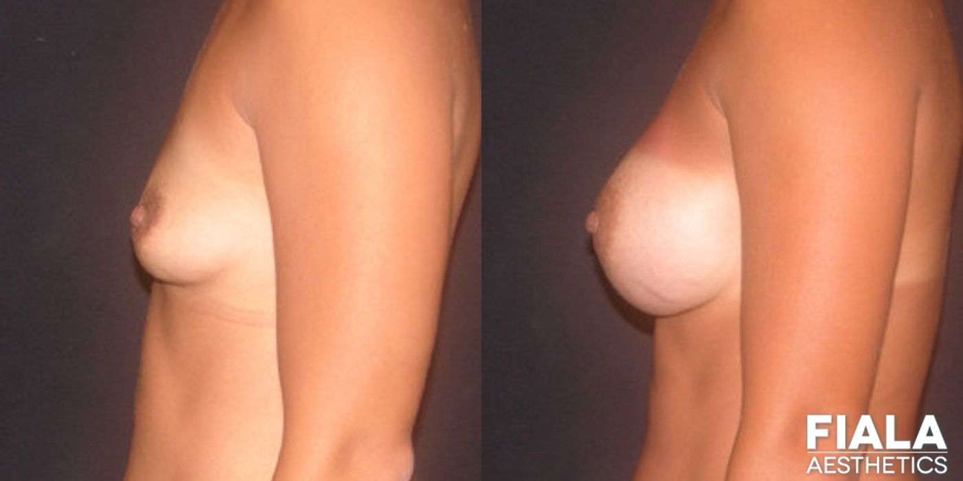 300cc Implants - Thumbnail 2