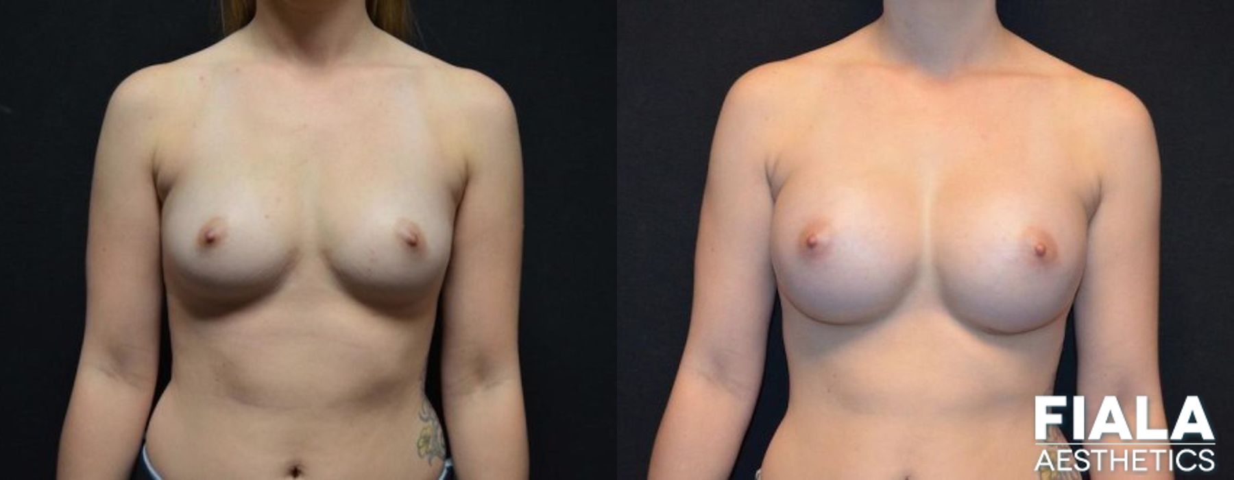 300cc Implants - Case 8887