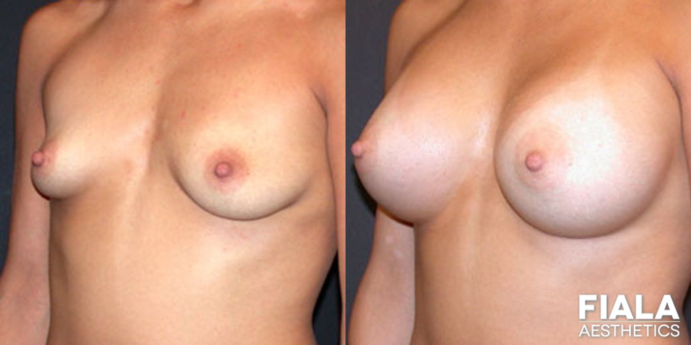 400cc smooth silicone breast implants placed beneath the muscle via dual plane approach through a 4cm inframammary incision - Angle 2