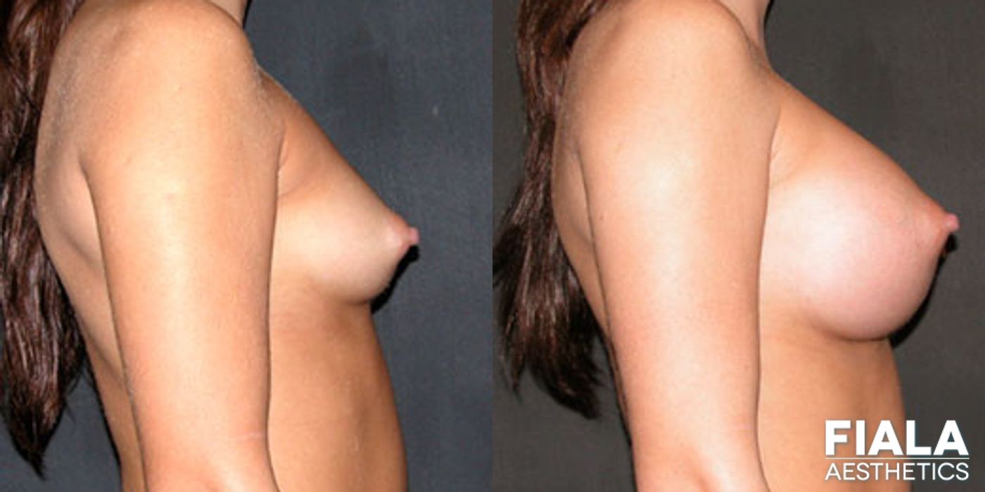 Before and after 400cc Implants case 13702 - Angle 2