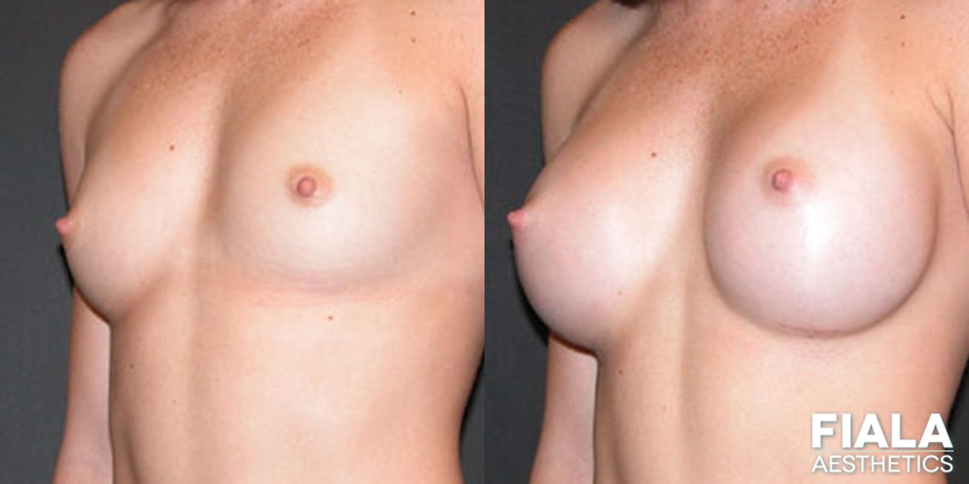 Before and after 400cc Implants case 14111