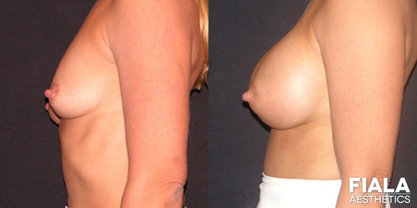 Before and after 400cc Implants case 14108 - Angle 2