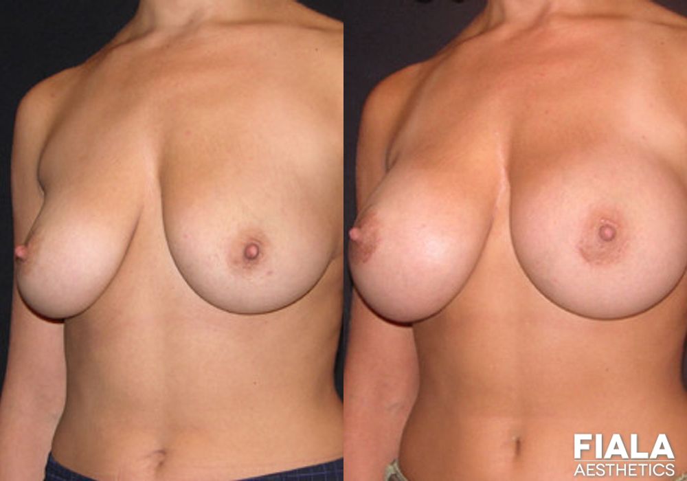 400cc Implants - Thumbnail 2