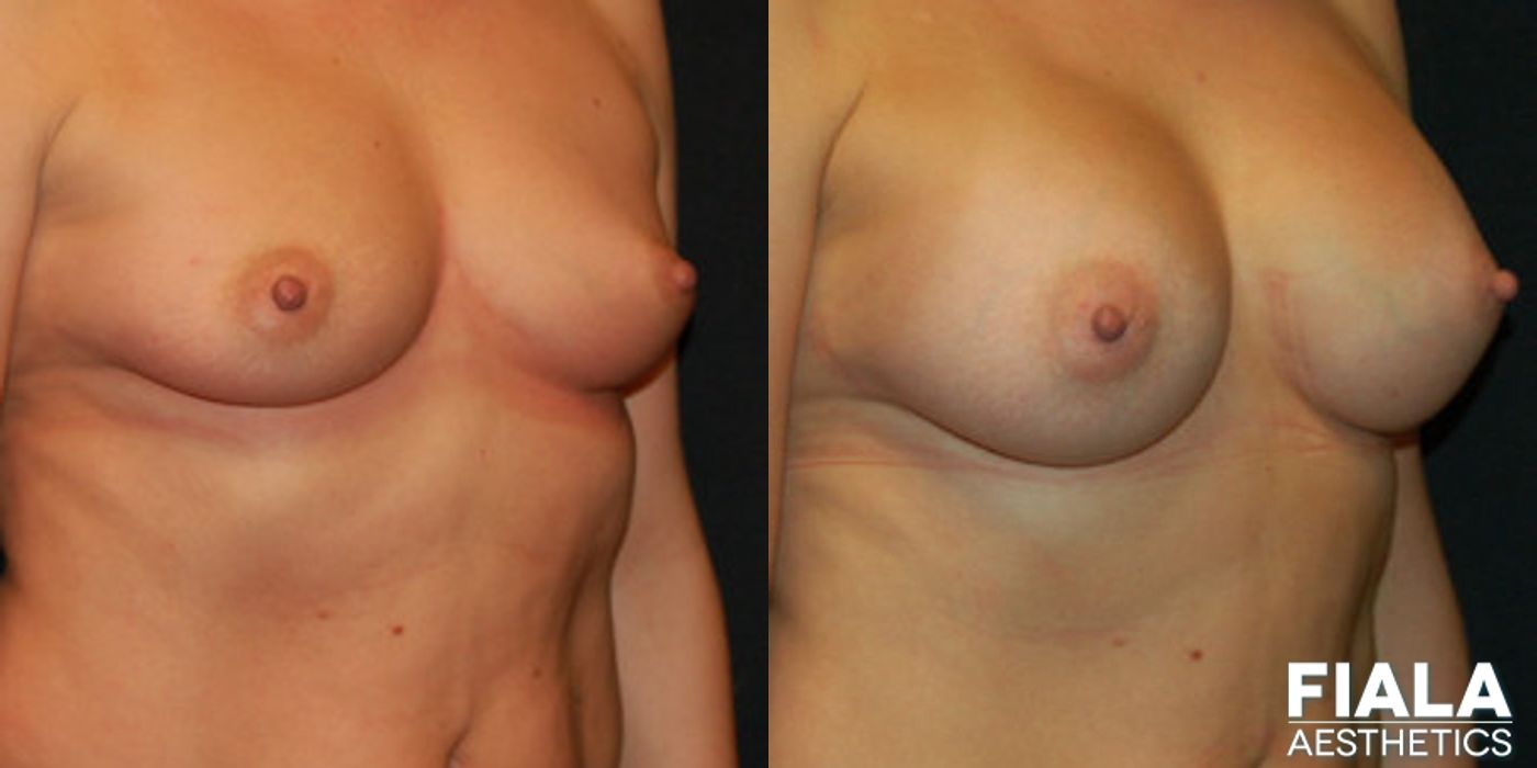 400cc Implants - Thumbnail 2