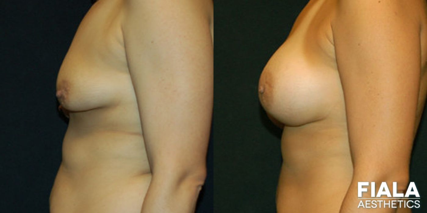 Before and after 400cc Implants case 13714 - Angle 2