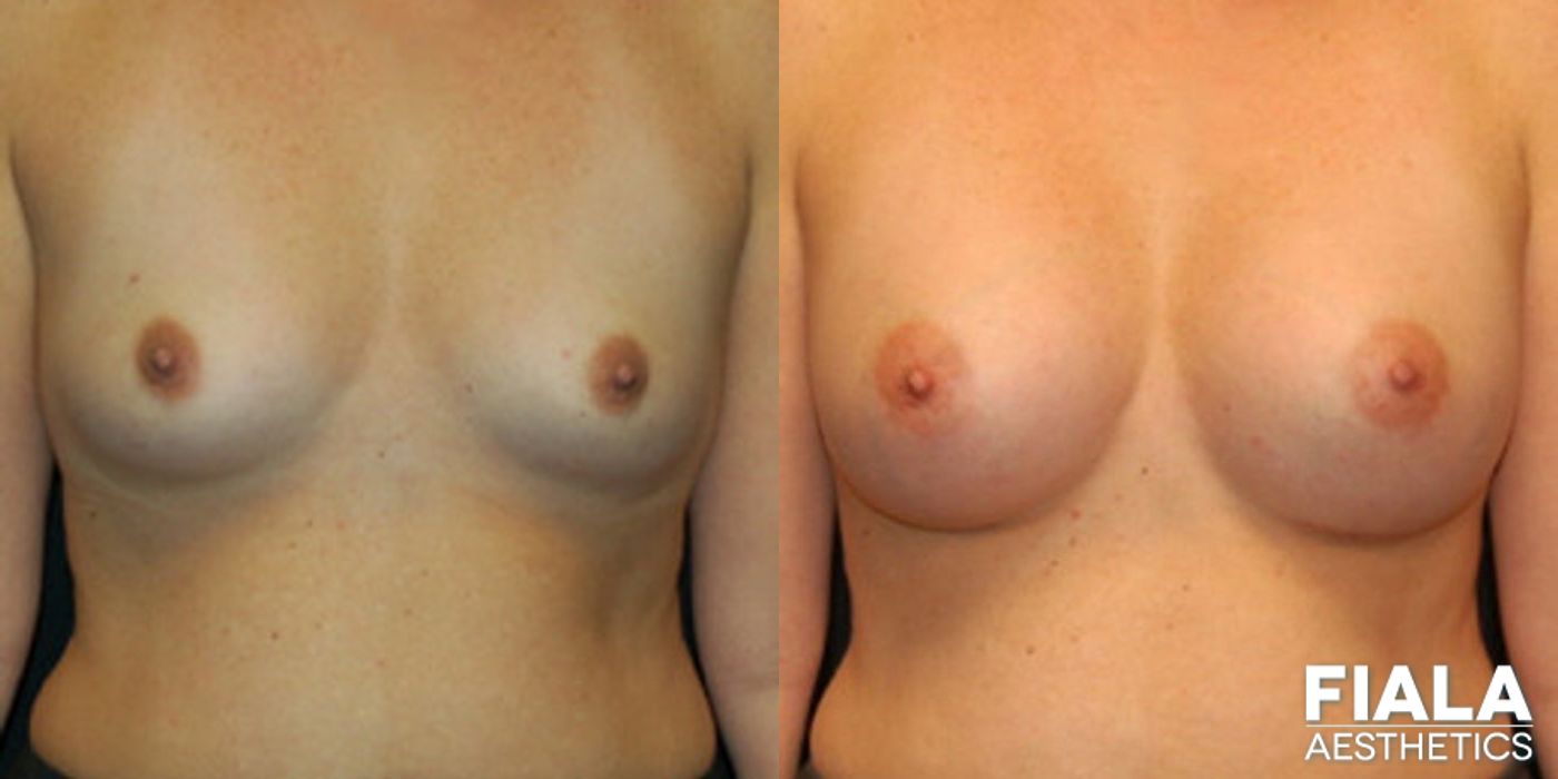 Before and after 400cc Implants case 13720