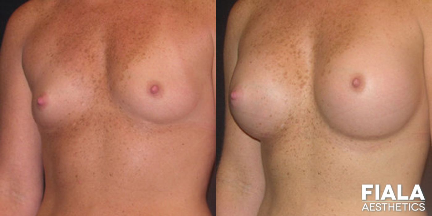 Before and after 400cc Implants case 13713 - Angle 2