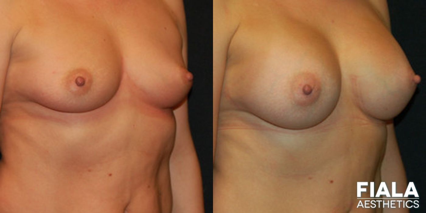 Before and after 400cc Implants case 13707 - Angle 2