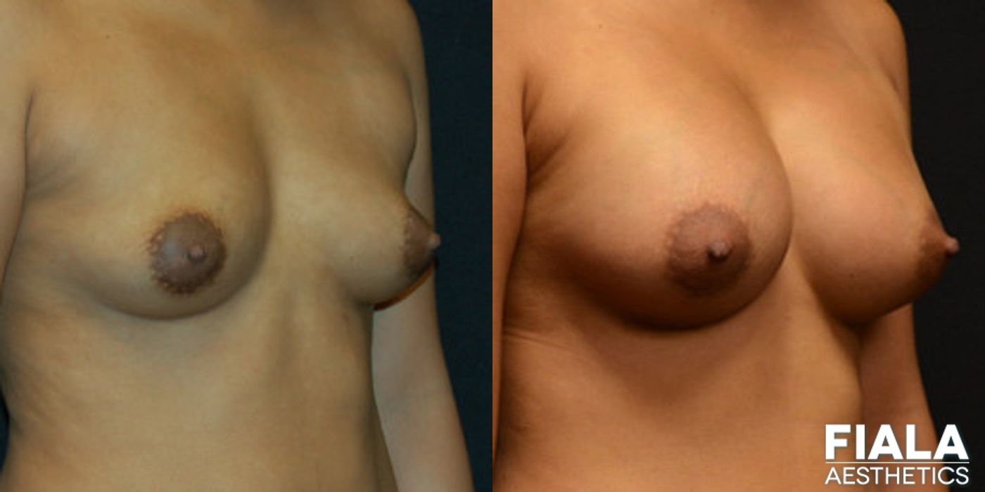 400cc Implants - Thumbnail 2