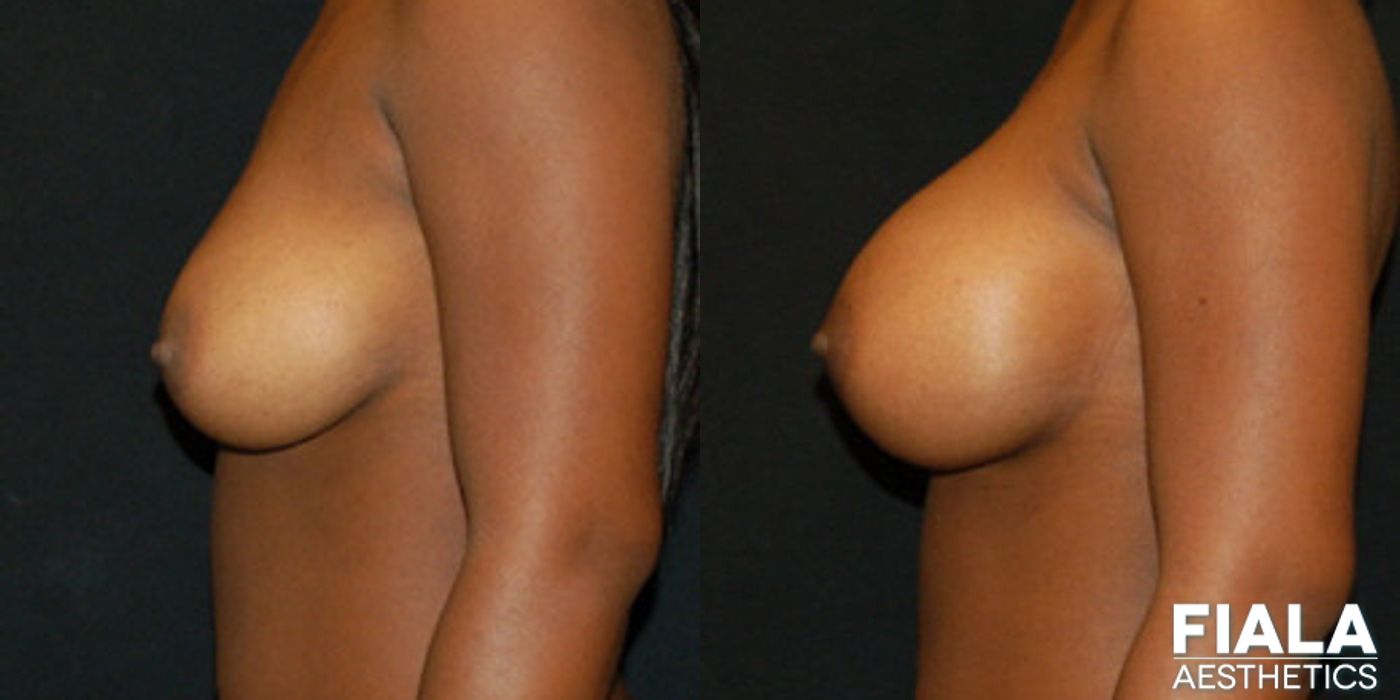 400cc Implants - Thumbnail 2