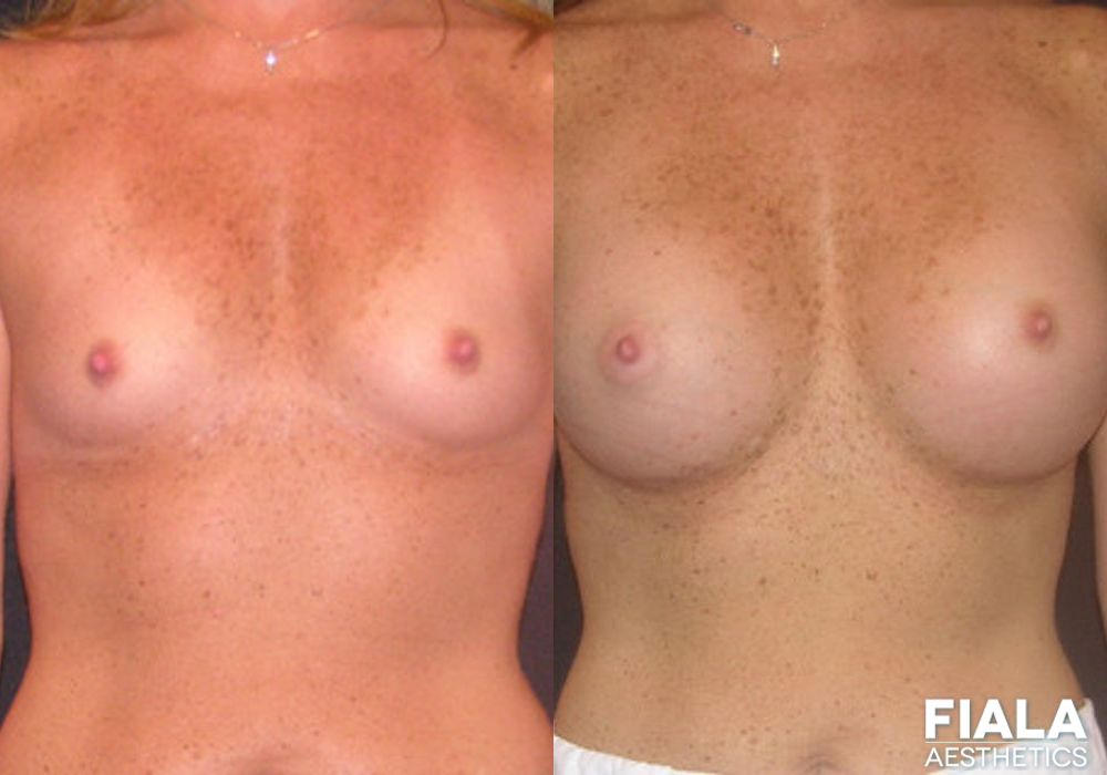 400cc Implants - Case 8920