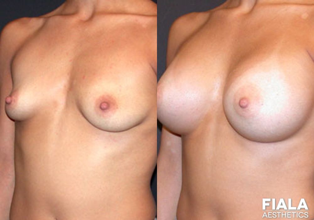 400cc Implants - Thumbnail 2