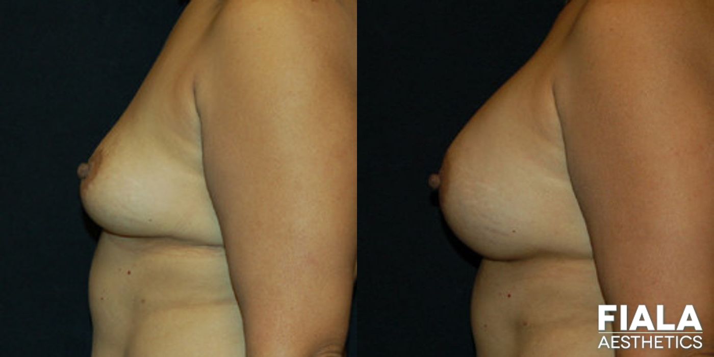 Before and after 400cc Implants case 13717 - Angle 2