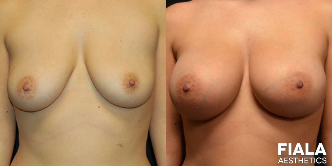 400cc Implants - Case 9143