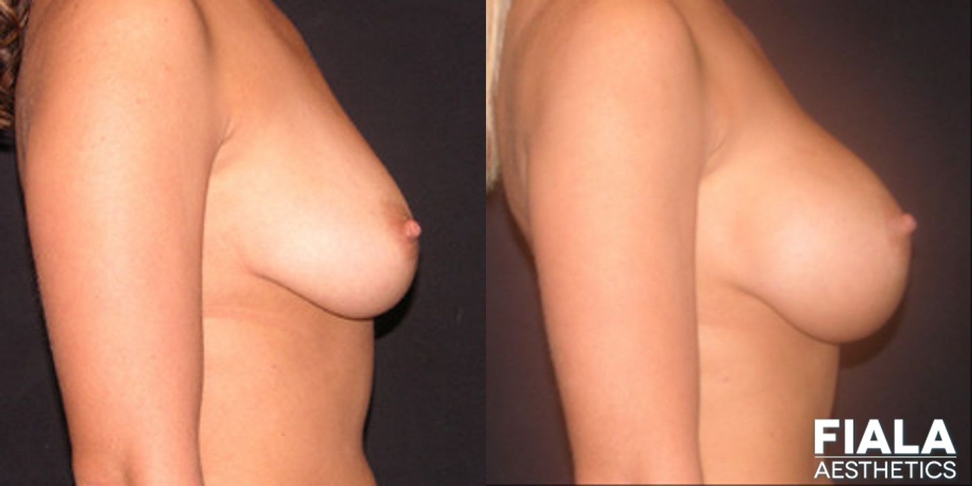 400cc Implants - Thumbnail 2