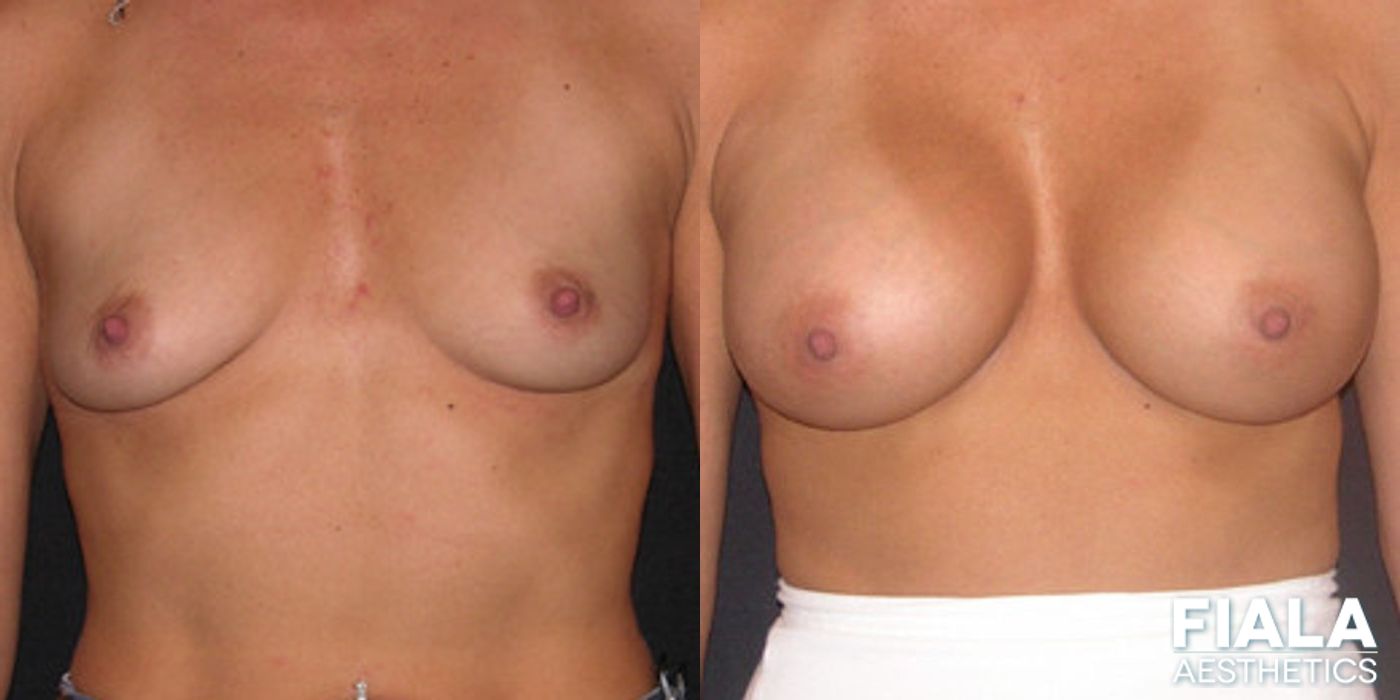 Before and after 400cc Implants case 14108