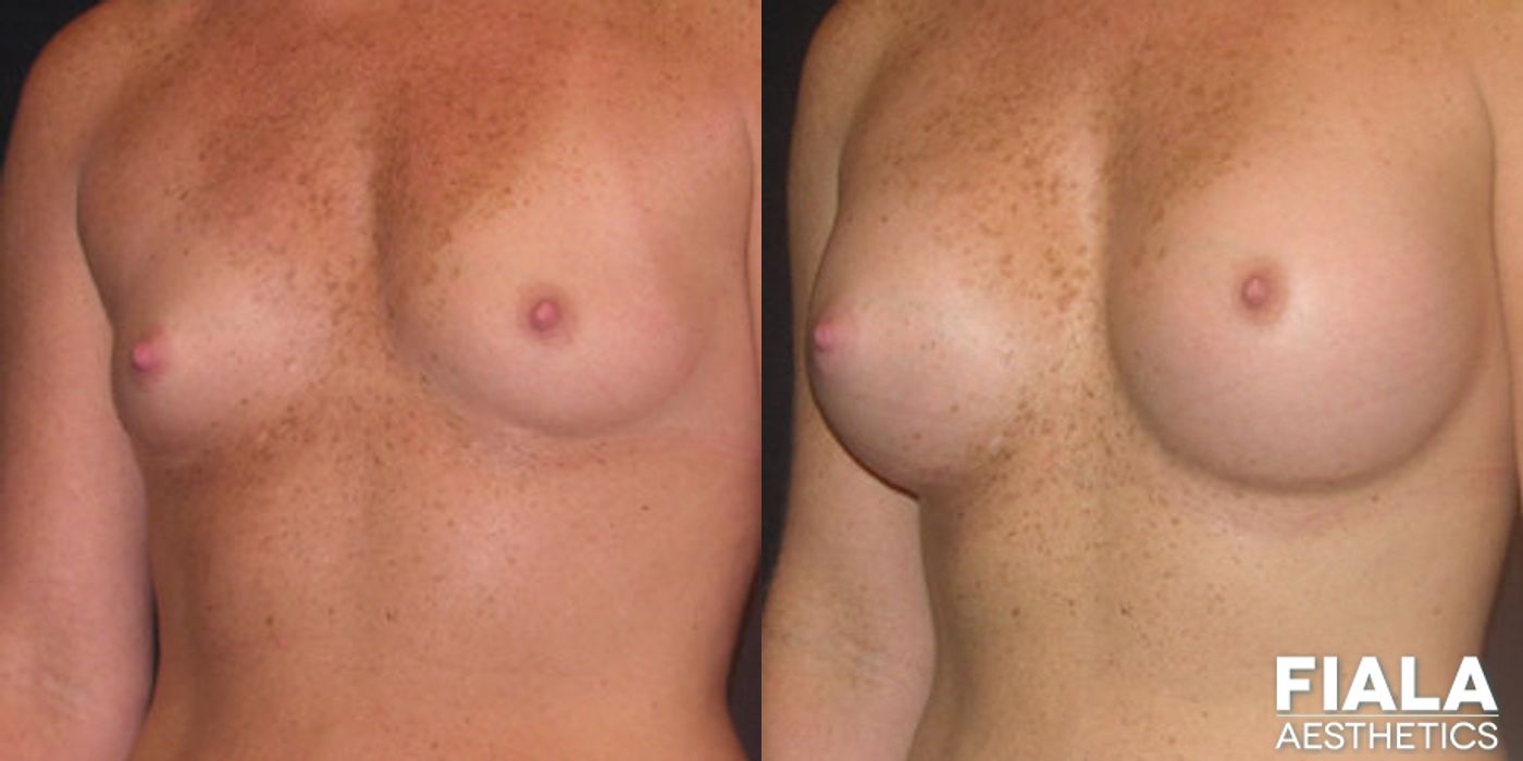 400cc Implants - Thumbnail 2