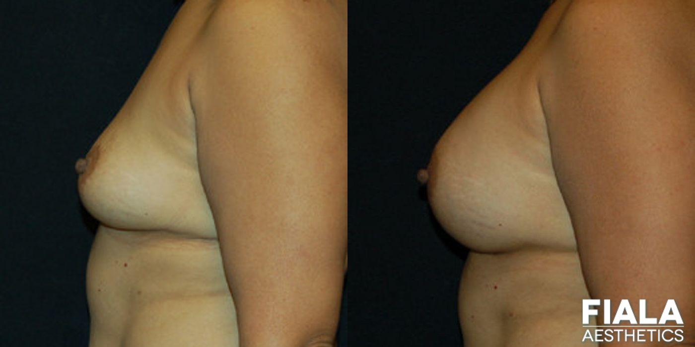 400cc Implants - Thumbnail 2