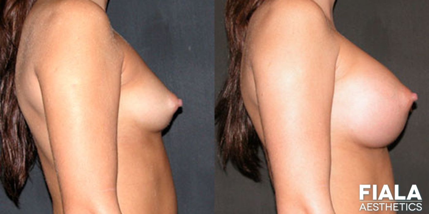 400cc Implants - Thumbnail 2