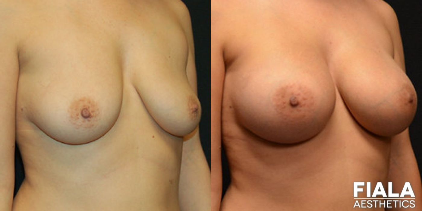 400cc Implants - Thumbnail 2