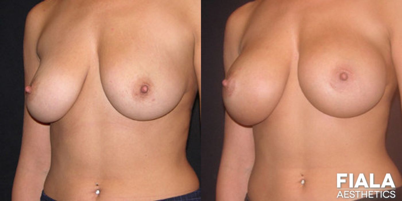 400cc Implants - Case 9149