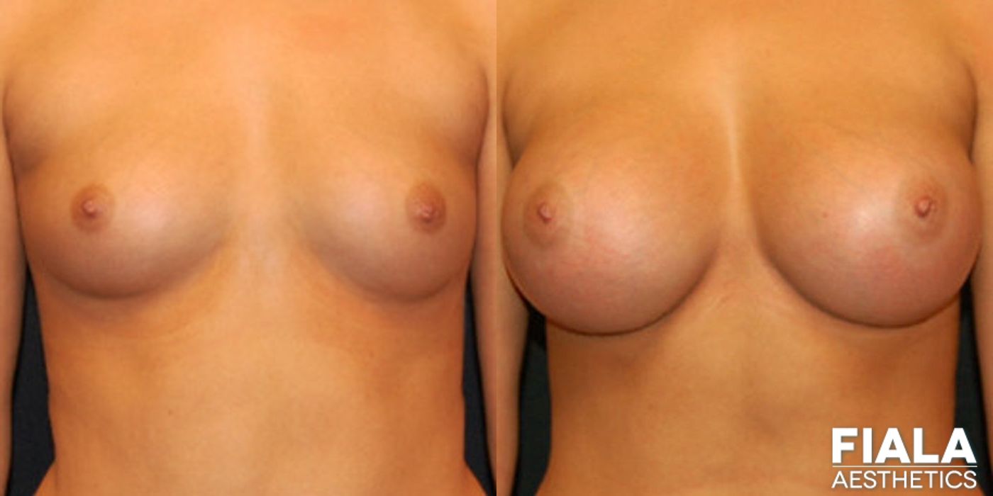 400cc Implants - Case 9138