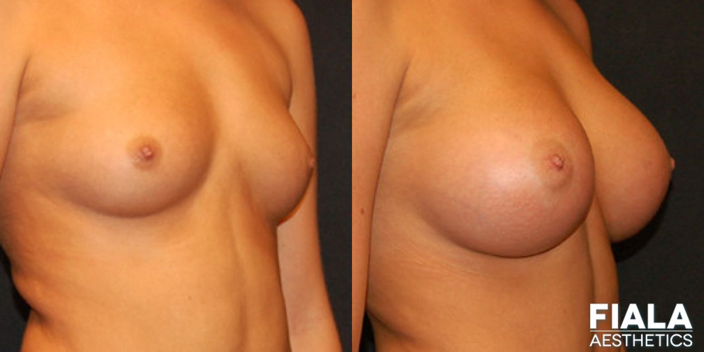 400cc Implants - Thumbnail 2