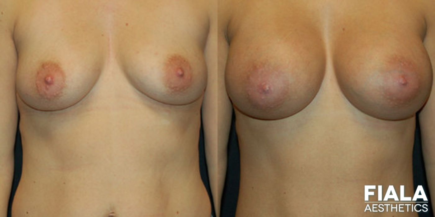 Before and after 400cc Implants case 13710
