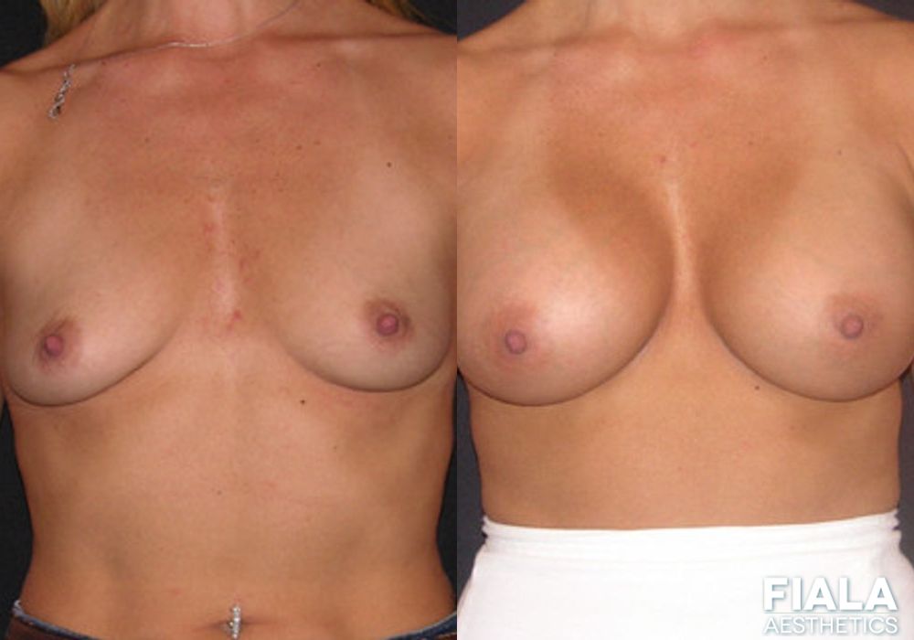 400cc Implants - Case 8929