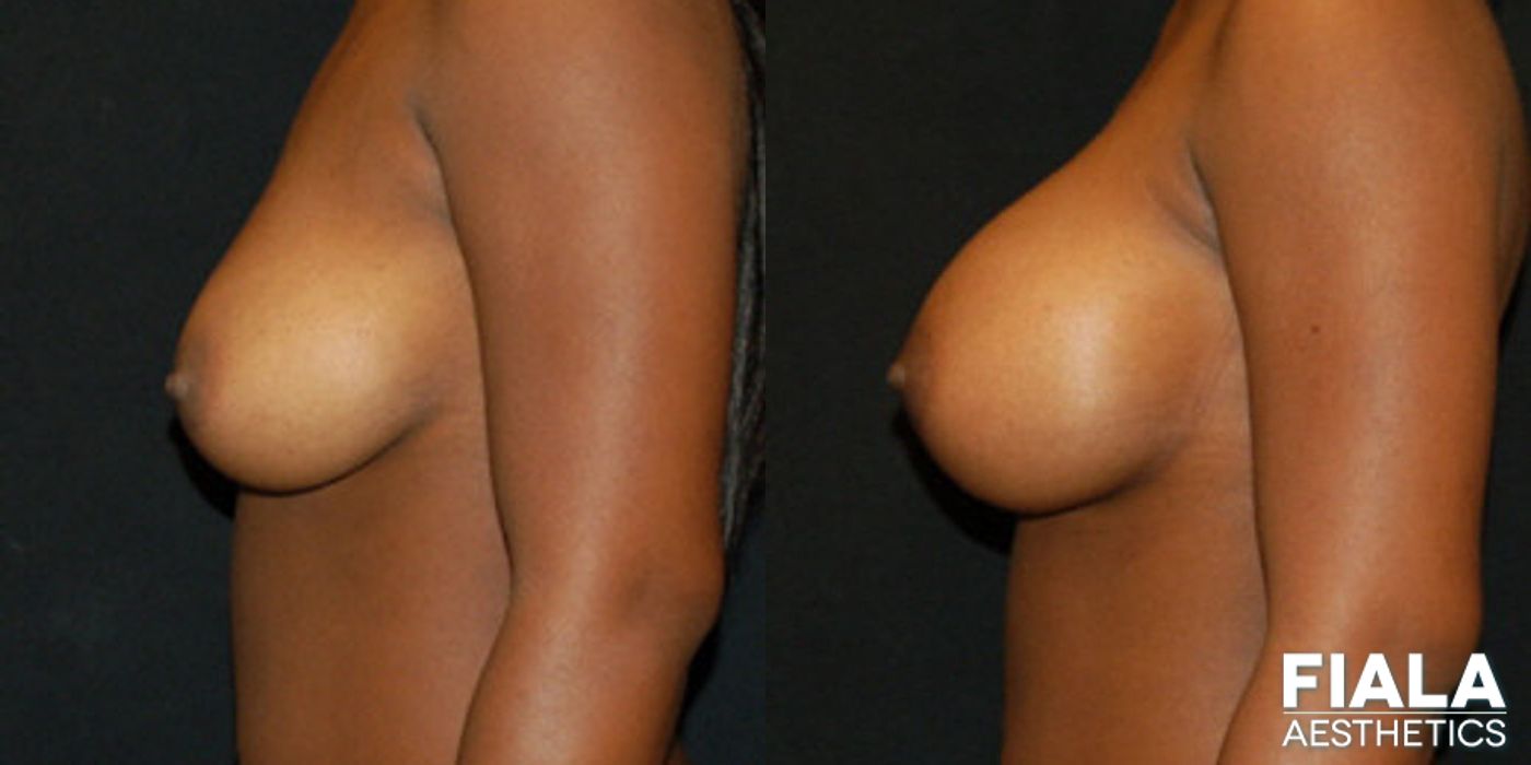 Before and after 400cc Implants case 13718 - Angle 2