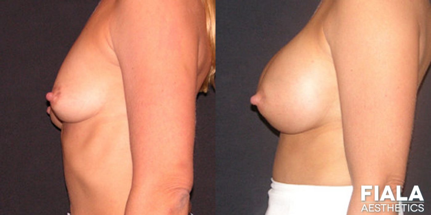 400cc Implants - Thumbnail 2