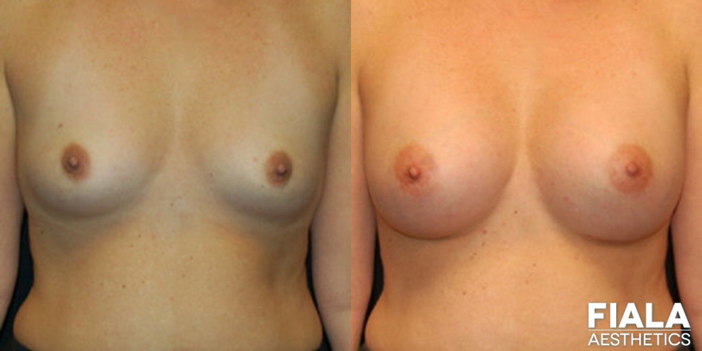 400cc Implants - Case 9147