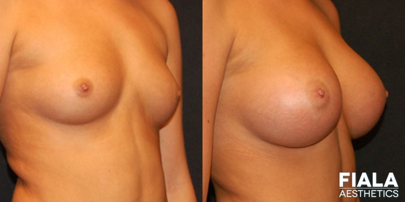 400cc breast implant before after Orlando - Angle 2